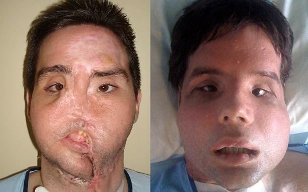 In this undated combo photo released by Vall d'Hebron Hospital, Oscar, a man who underwent a full-face transplant in April appears before, left, and after, right, the surgery. (AP)