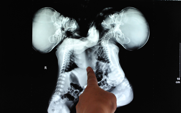 A doctor points to an x-ray film of female conjoined twins during a medical consultation at a hospital in Chongqing municipality. The twins, who were born on July 6 in Guizhou province, went to Chongqing for better medical treatment on Tuesday. They await a medical evaluation to decide on the procedure for their separation, local media reported. (REUTERS)