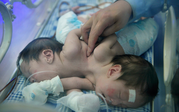 Female conjoined twins receive a medical examination at a hospital in Chongqing municipality. The twins, who were born on July 6 in Guizhou province, went to Chongqing for better medical treatment on Tuesday. They await a medical evaluation to decide on the procedure for their separation, local media reported. (REUTERS)