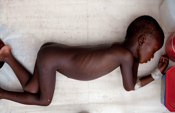 Wilson, 4, receives treatment for cholera symptoms at a cholera treatment center in Mirebalais, Haiti. Cholera has sickened at least 370,000 people and killed more than 5,500 since the outbreak started in October, according to the Health Ministry. (AP)