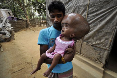 Indian labourer Abdul Rahman holds his daughter, Roona Begum, who has hydrocephalus, in Tripura state on April 12, 2013 (AFP)