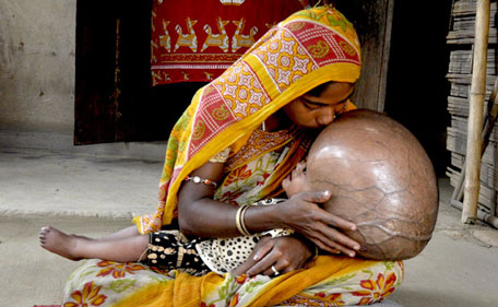 Fatima Khatun kisses the head of her eighteen month old daughter, Roona Begum, suffering from Hydrocephalus--a buildup of fluid inside the skull that leads to brain swelling--at their hut in the village of Jirania on the outskirts of Agartala. (AFP)