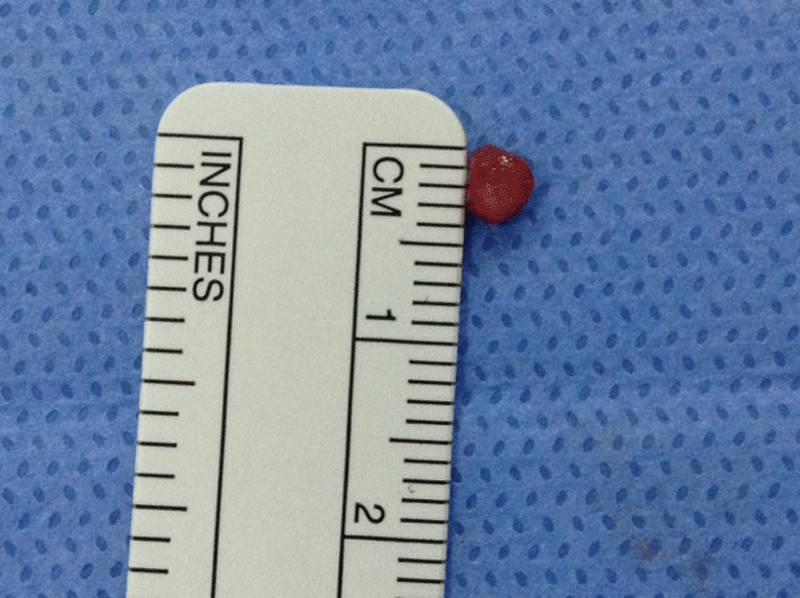 Tumour 3 mm in size was extracted