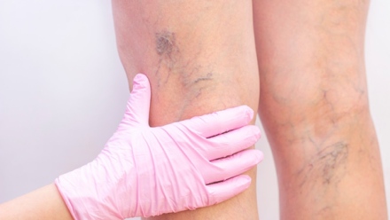 Photo: The Ultimate Guide to Varicose Veins: Causes, Symptoms, and Advanced Treatments in Dubai